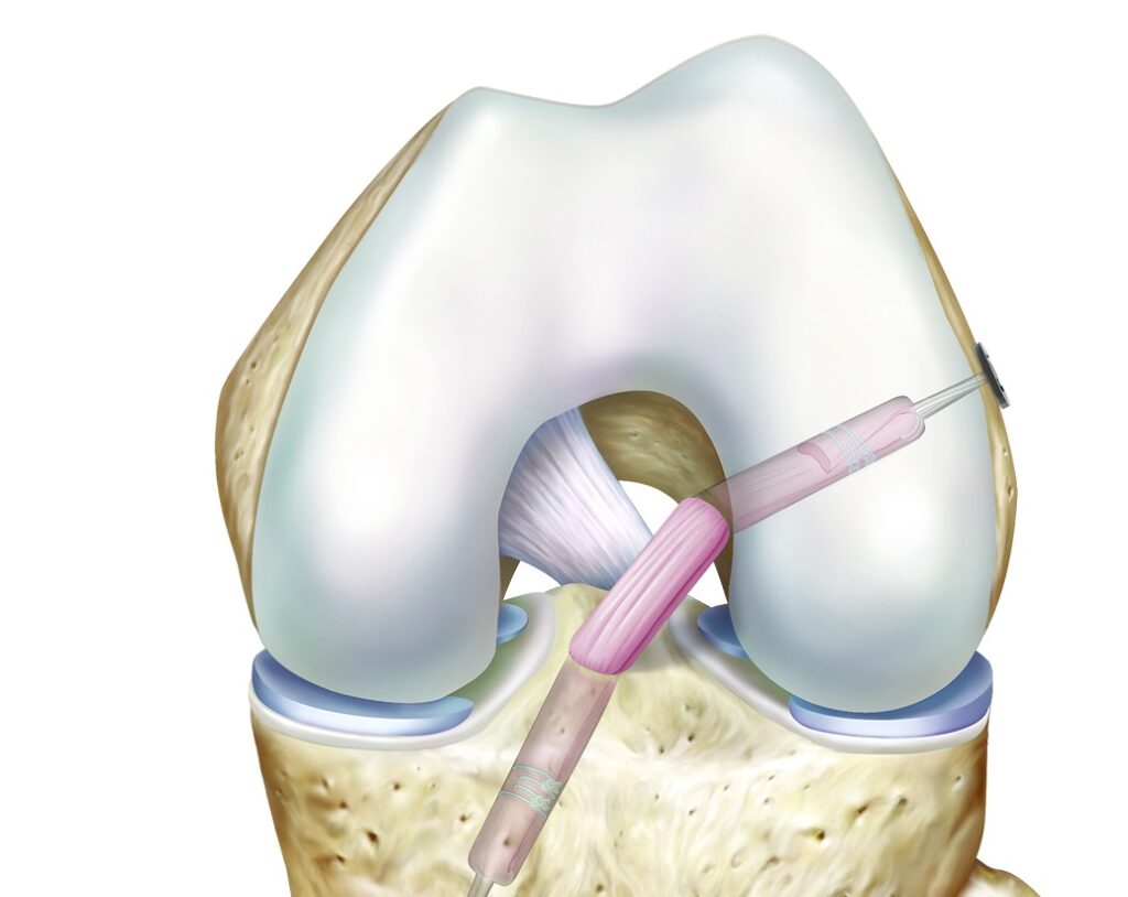 ACL Repair