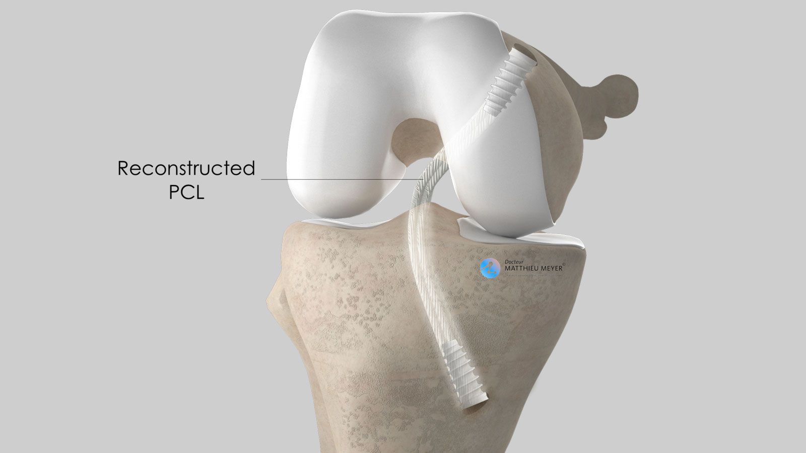 PCL Repair