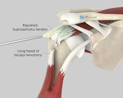 Rotator Cuff Repair Surgery